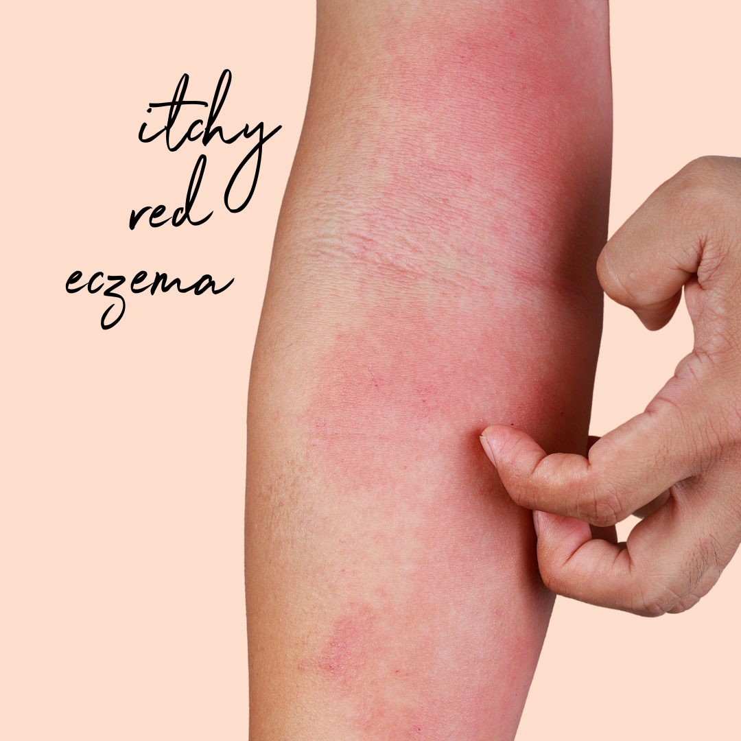 dermatitis